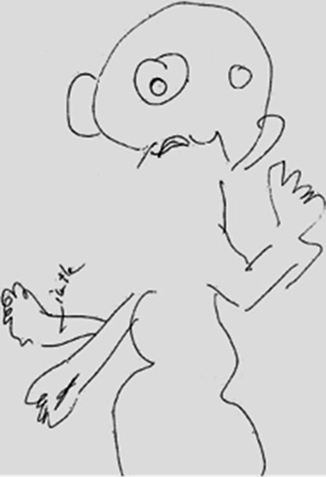 Dessin publié dans l’article de Khated et coll., 2009. La patiente a représenté graphiquement le bras fantôme surnuméraire qu’elle sent présent à partir de son coude droit. C’est avec ce membre fantôme qu’elle a gratté sa joue et produit (dans la zone corticale sensorielle attendue) un corrélat neuronal bien identifié sous Résonance Magnétique fonctionnelle.
