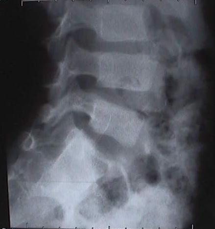 Radio de profil de L 5