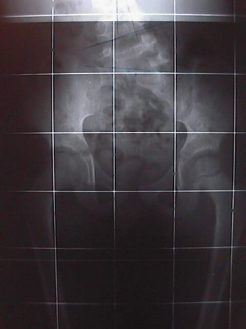 Radio du bassin de face