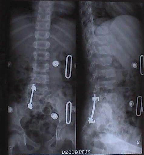 Contrôle radiologique postopératoire