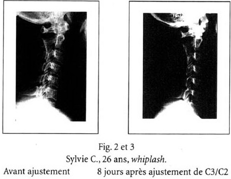 Fig. 2 et 3 - Sylvie C., 26 ans, whiplash. Fig. 2 et 3 - Sylvie C., 26 ans, whiplash.