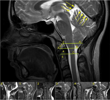 Malformation Arnold Chiari – Classification de l'ampleur de la descente des amygdales cérébelleuses avec des exemples pour chaque degré