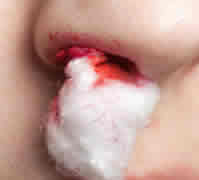 epistaxis-logo.jpg